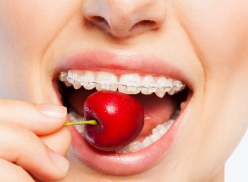 Braces-Friendly Foods: Tips for Healthy Eating During Treatment braces-friendly foods